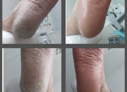 Трещины на пятках? Не проблема!