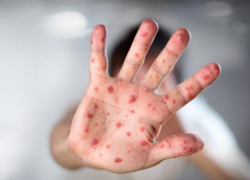 Врачи бьют тревогу: по краю и в Анапе участились случаи заболевания корью