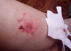 «Анапа должна быть безопасным городом»: агрессивная бездомная собака покусала москвичку