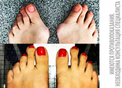 Честные ответы авторитетного хирурга о шишках на ногах