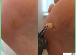 Стрежневая мозоль – маленькая, но болезненная