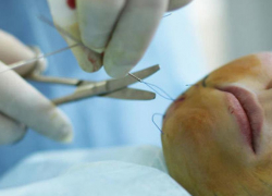 55-летняя анапчанка легла под нож ради 35-летнего ухажёра