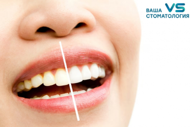 Отбеливание зубов в клинике «Ваша стоматология»  