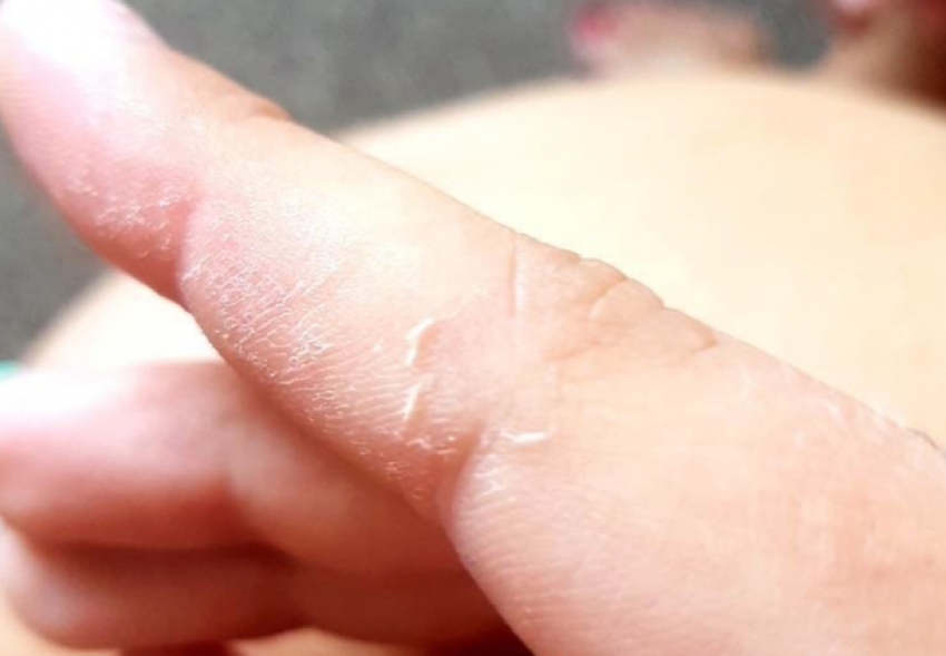 Правда ли, что у школьников в Анапе от антисептика разъедает кожу на руках?