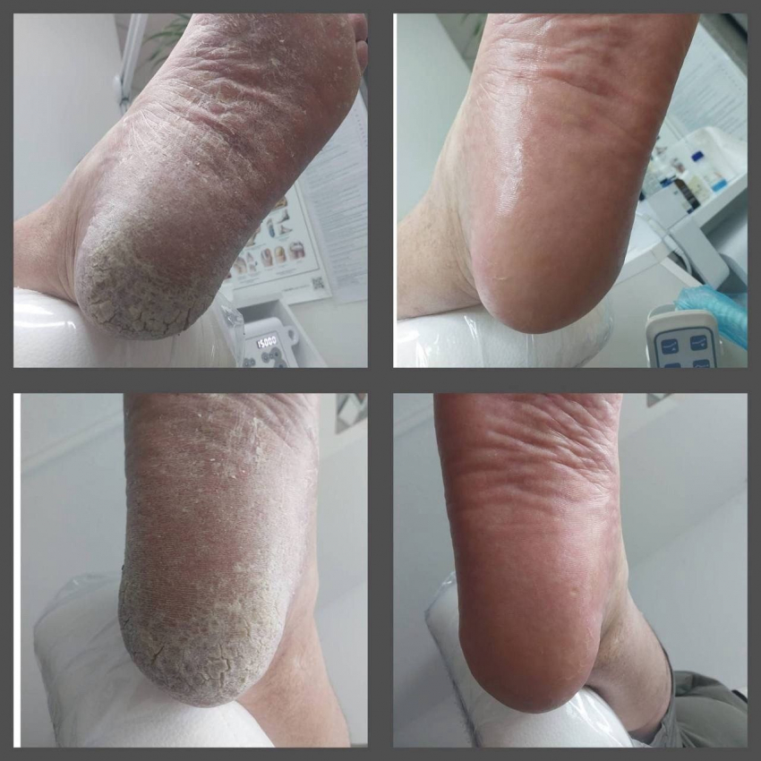 Трещины на пятках? Не проблема!