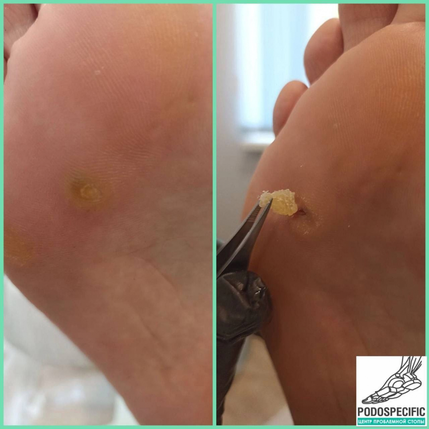Стрежневая мозоль – маленькая, но болезненная