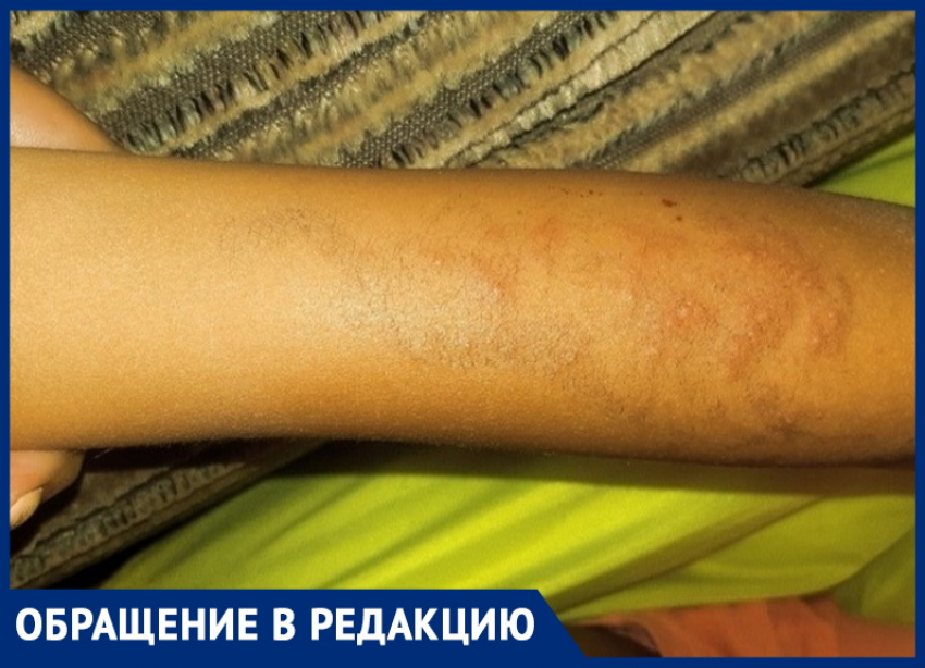 В Анапе Ксения Бебиашвили заплатила 4000 р. за тату, превратившиеся в рубцы и волдыри